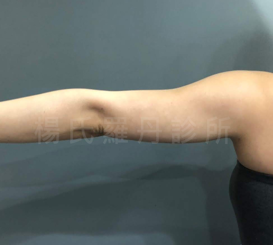 楊氏羅丹雷射減脂